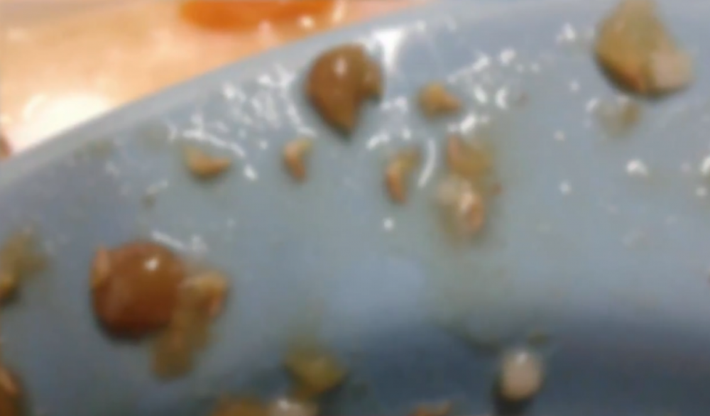 No refeitório do hospital, outra funcionária se assustou ao reparar que a sopa servida estava cheia de larvas - RICTV Record/Reprodução/ND