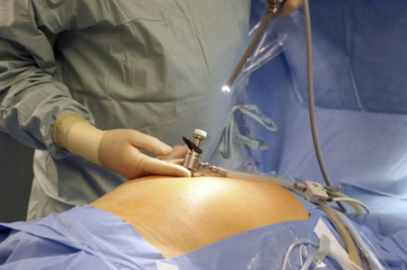 Cirurgia reduz o tamanho do estômago e é usada para casos de obesidade &#8211; Reprodução
