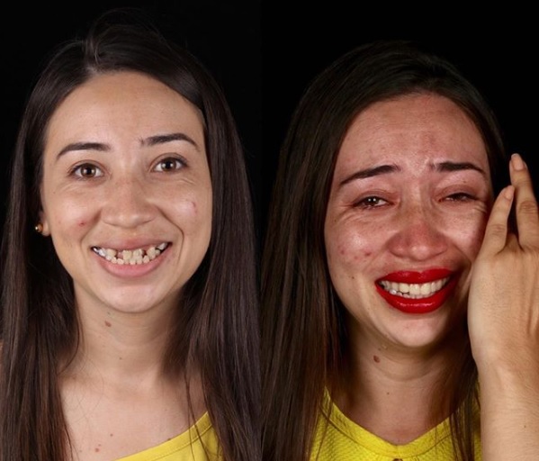 Daniele Souza, de 26 anos, moradora de Nova Olinda, não escondeu a emoção com o novo sorriso - Reprodução/Instagram