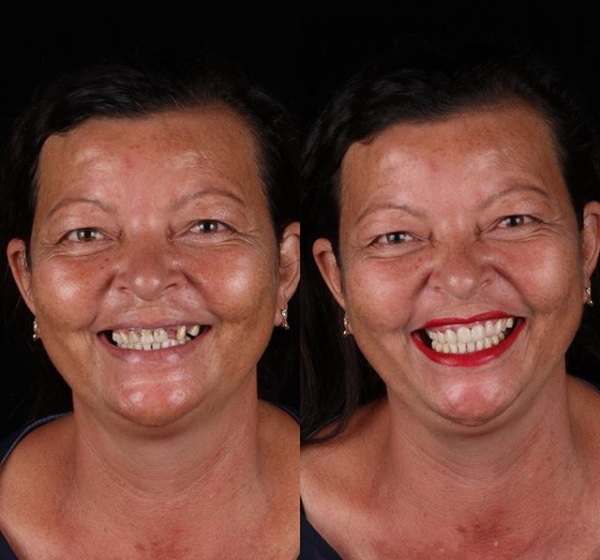 “A gente cuida da boca inteira do paciente de acordo com o que ele precisa, com atendimento gratuito”, afirma o dentista. Dona Célia, de Nova Olinda, adorou. - Reprodução/Instagram