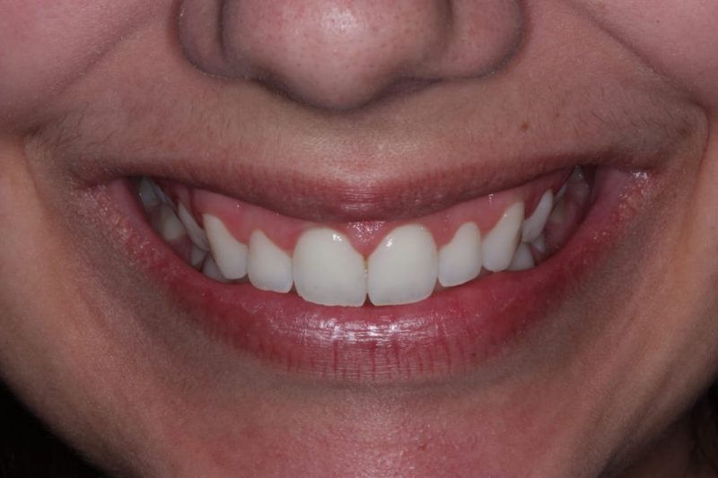 Paciente que encontrou a solu&ccedil;&atilde;o para o excesso gengival