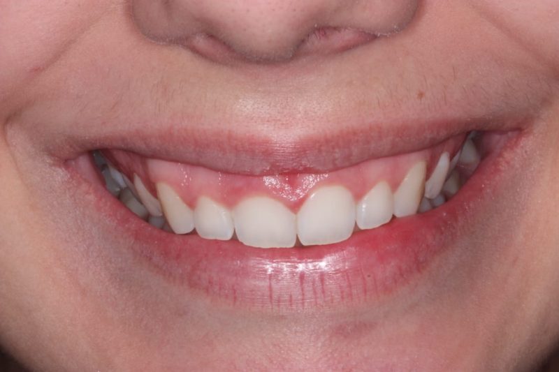 Antes e depois do tratamento das gengivas – Foto: Divulga&ccedil;&atilde;o