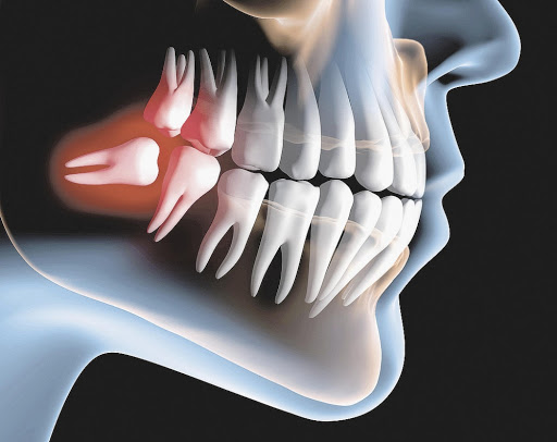Caso em que o dente siso está mal posicionado e precisa ser extraído &#8211; Foto: Divulgação