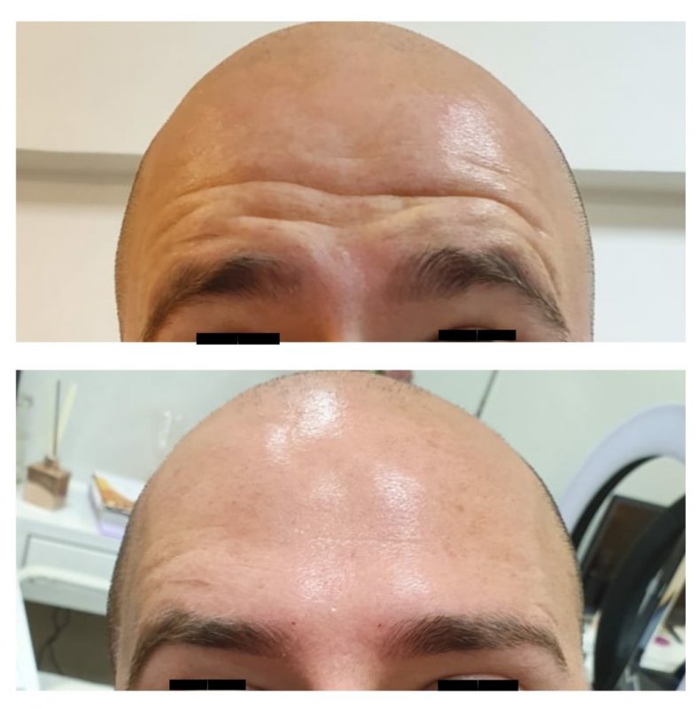 Cliente que teve rugas amenizadas com Botox – Foto: Divulga&ccedil;&atilde;o