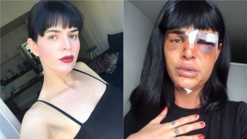 A modelo trans Alice Felis, vítima de agressão e latrocínio no Rio de Janeiro, chega em Blumenau para cirurgia de reconstrução facial – Foto: Reprodução/Instagram