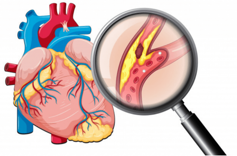 Imagem mostra coração visto por uma lupa, nele aparece colesterol em uma das veias