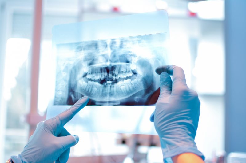 Exames aprofundados garantem segurança para implantes dentários. – Foto: Getty Images/iStockphoto/ND