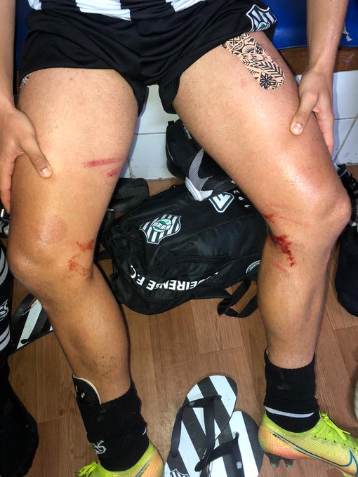 Marcas na perna do lateral Sanchez ap&oacute;s a dividida com Pedro Castro; atleta postou em seu perfil na rede social as marcas do lance que o Figueirense reivindicou falta – Foto: Reprodu&ccedil;&atilde;o/ND