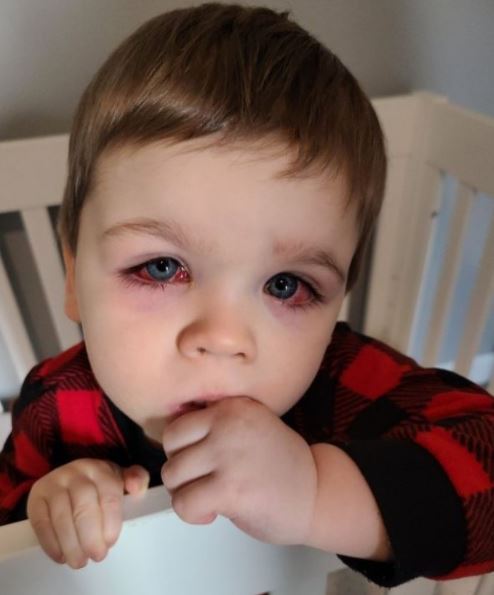 O olho ficou t&atilde;o inchado que o menino n&atilde;o conseguia fechar os olhos – Foto: Reprodu&ccedil;&atilde;o/Eden Strong