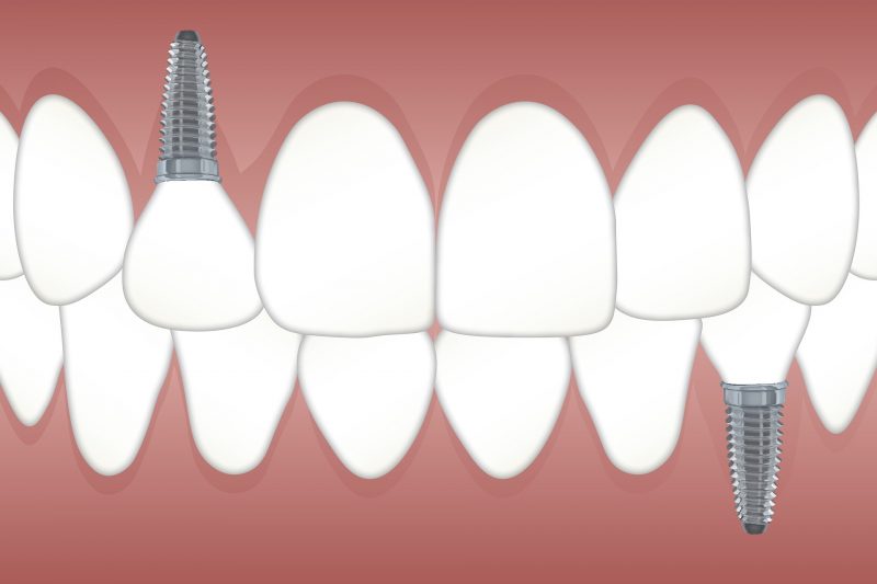 Saiba o que são os implantes dentários – Foto: Divulgação