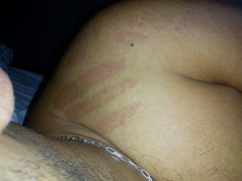 Marcas misteriosas apareceram no ombro de um rapaz, em Garuva &#8211; Foto: Divulgação/Arquivo Pessoal/ND