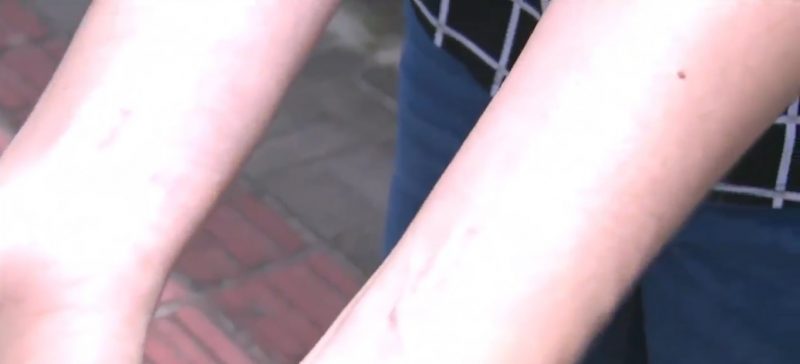 Rep&oacute;rter B&aacute;rbara Barbosa mostra marcas das agress&otilde;es – Foto: NSCTV/Reprodu&ccedil;&atilde;o/ND