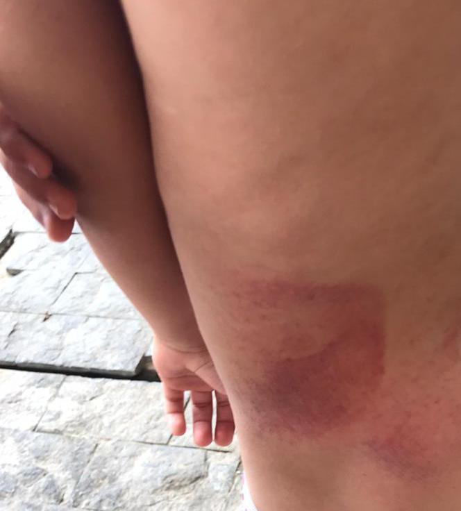 Menino com marcas de agressão nas costas.