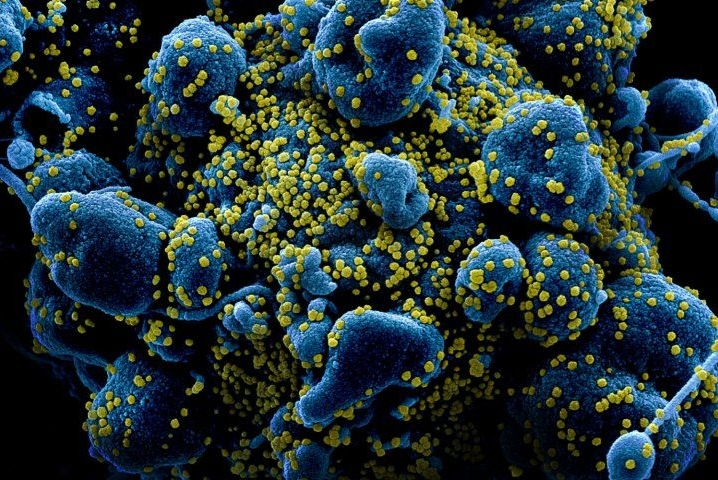 Homem teria participado de uma reunião de família um dia antes de ser diagnosticado com a doença – Foto: NIAD/NIH/Reprodução/ND
