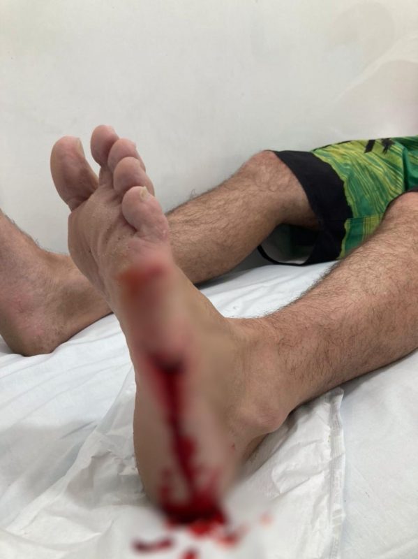 Surfista é mordido por animal marinho em Navegantes. – Foto: Corpo de Bombeiros Militar/Divulgação