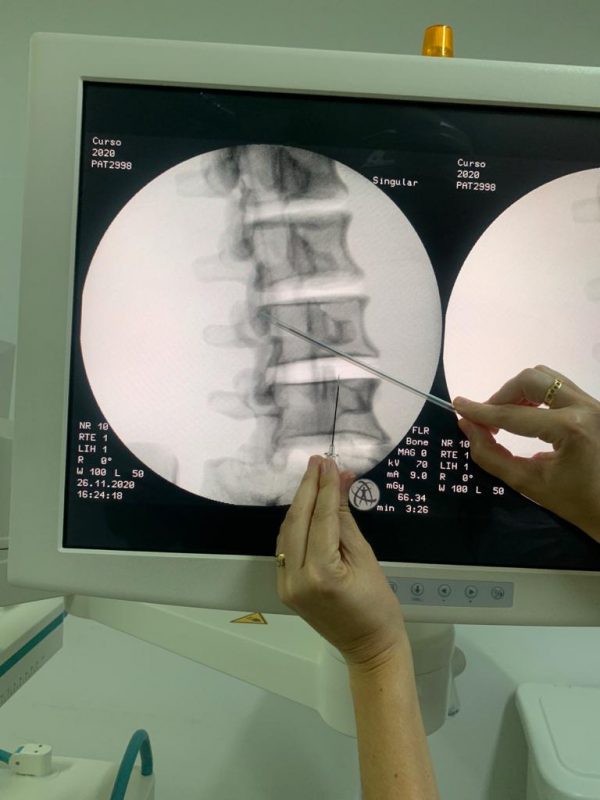 Local da dor recebe medicamentos nas t&eacute;cnicas da medicina intervencionista – Foto: Divulga&ccedil;&atilde;o/ND