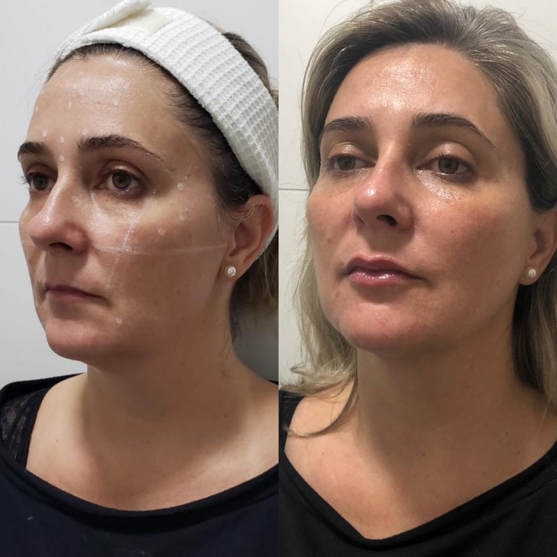 Harmoniza&ccedil;&atilde;o facial feita com apenas 3mls de &aacute;cido hialur&ocirc;nico em pontos de sustenta&ccedil;&atilde;o da face, trazendo rejuvenescimento facial natural – Reprodu&ccedil;&atilde;o/ Instagram da Doutora Luisa Caser / ND
