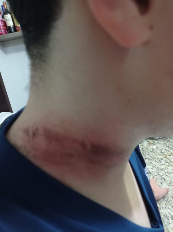 Adolescente de 17 anos ficou ferido ao se enroscar em um fio solto na calçada em Blumenau – Foto: Arquivo pessoal