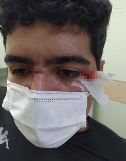 Andrei teve um corte no nariz e outro próximo ao olho esquerdo – Foto: Arquivo Pessoal