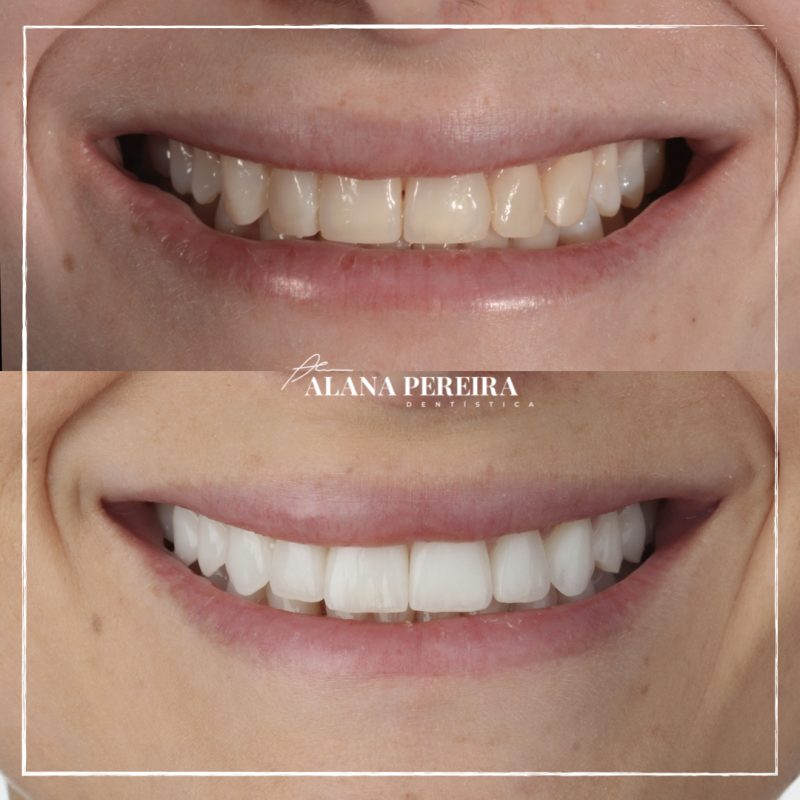 Foto com facetas de porcelana – Reprodução/ Instagram Doutora Alana Pereita/ ND
