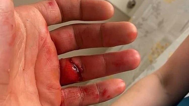 Lutador passou por cirurgia – Foto: Twitter/Reprodução/ND