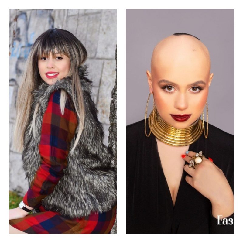 Dançarina com alopecia abandona peruca e inspira outras mulheres: careca e  linda, Celebridades