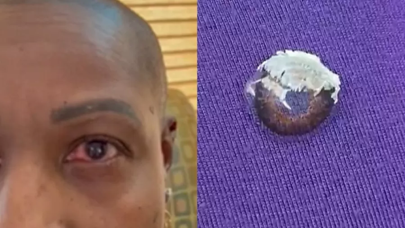 Mulher quase ficou cega ap&oacute;s confundir cola com col&iacute;rio – Foto: Reprodu&ccedil;&atilde;o/WXYZ