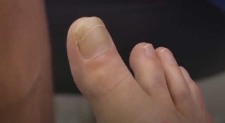Paciente chocou cirurgião especializado em pés com um dedão extremamente longo e raro – Foto: REPRODUÇÃO/TCL/MY FEET ARE KILLING ME