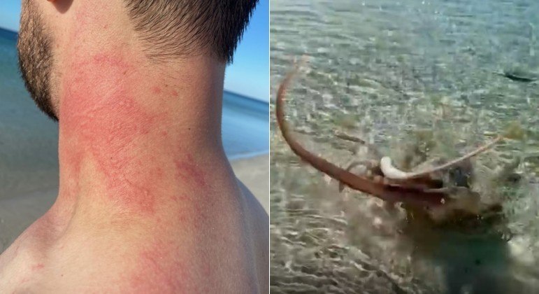 Polvo golpeou o pesco&ccedil;o de banhista com um dos tent&aacute;culos, em praia na Austr&aacute;lia – Foto: Reprodu&ccedil;&atilde;o/Instagram/ND