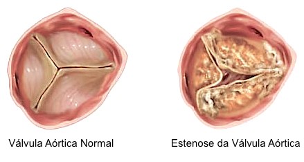 Diferença entre uma válvula saudável e uma com estenose – Foto: Divulgação/Centro Hospitalar de Vila Nova de Gaia