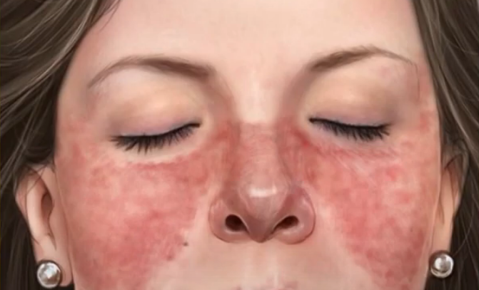 Estima-se que existam cerca de 65.000 pessoas com lúpus no Brasil