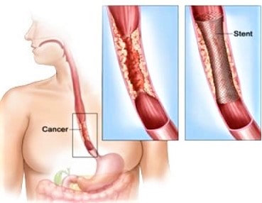 C&acirc;ncer de es&ocirc;fago tem tratamento, mas &eacute; necess&aacute;rio diagn&oacute;stico precoce – Foto: Divulga&ccedil;&atilde;o
