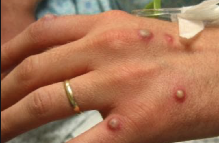 Os doentes com varíola dos macacos desenvolvem uma erupção na pele que pode formar bolhas &#8211; Foto: Reprodução/ND