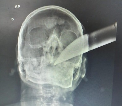 Homem ficou com um facão cravado na cabeça em SC &#8211; Foto: PM/Divulgação