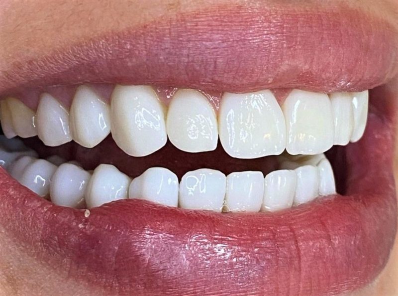 Sonho de ter dentes perfeitos pode ser realizado – Foto: Divulgação Oral Visage