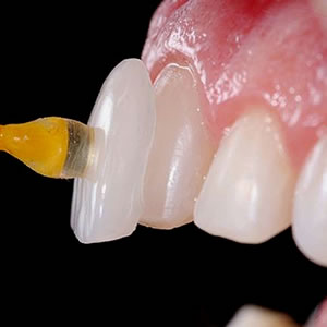Clínica atende clientes que querem colocar lentes dentais – Foto: Divulgação Oral Visage