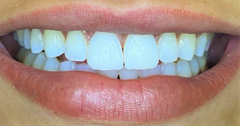 Funcionalidade pode ser reconquistada, com agilidade e conforto – Foto: Divulgação Oral Visage