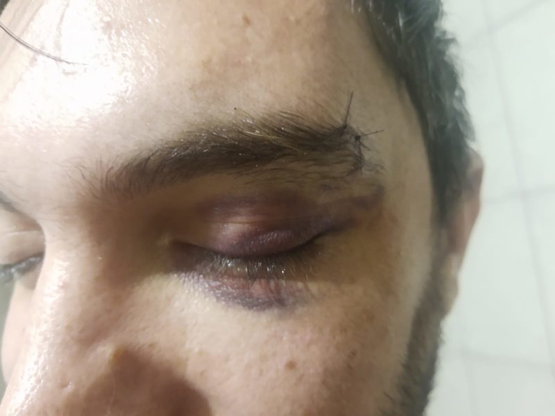 Anderson sofreu hematomas e precisou levar pontos – Foto: Arquivo/ND