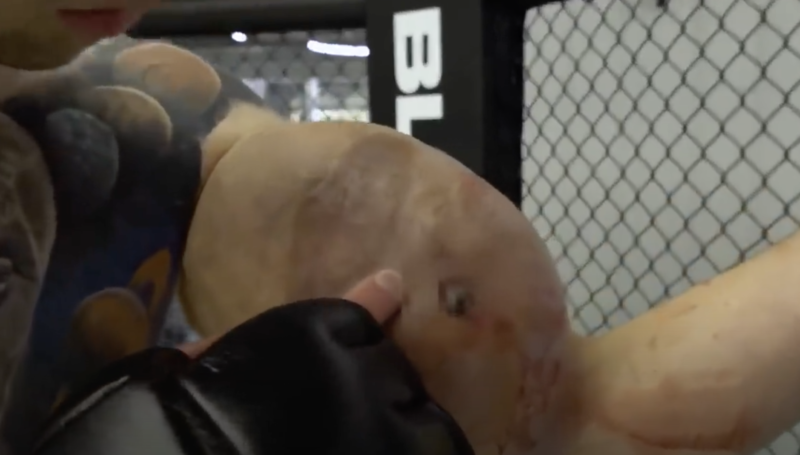 Bíceps de lutador de MMA explodiu durante e corre risco de amputação – Foto: Reprodução