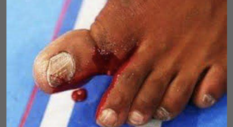 A imagem é forte. O dedão fraturado pertence a Jon Jones, resultado da luta contra Chael Sonnen, em 2013. Apesar da lesão, Jones venceu e manteve o cinturão – Foto: Reprodução