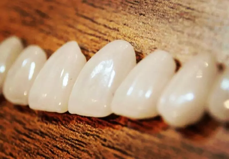 Lentes de contato de porcelana têm sido muito utilizadas – Foto: Divulgação Oral Visage