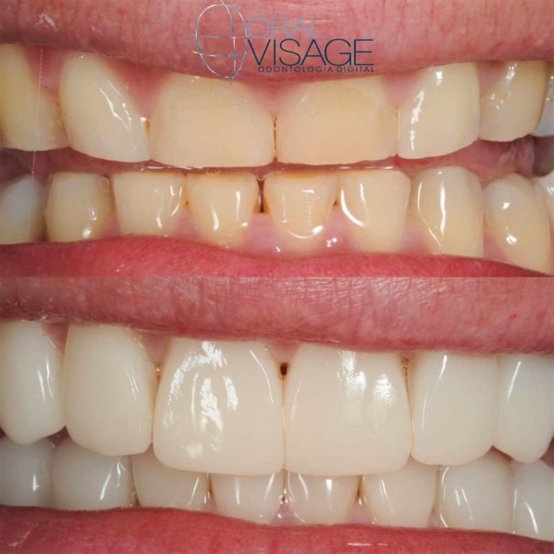 Técnicas com fluxo digital transformam sorrisos – Foto: Divulgação Oral Visage
