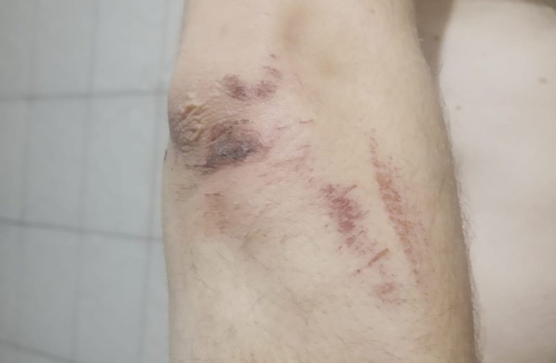 hematomas