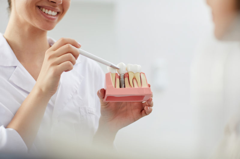 <span style="font-weight: 400;">Os implantes dentários devolvem funções e a autoestima através do sorriso</span> – Foto: Divulgação
