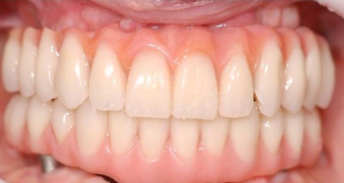 Paciente com tratamento conclu&iacute;do em 2021 – Foto: Divulga&ccedil;&atilde;o Bianchini Odontologia