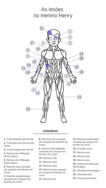 Imagem mostra les&otilde;es identificadas pelos peritos no corpo do menino Henry, morto aos quatro anos – Foto: UOL/Reprodu&ccedil;&atilde;o/ND