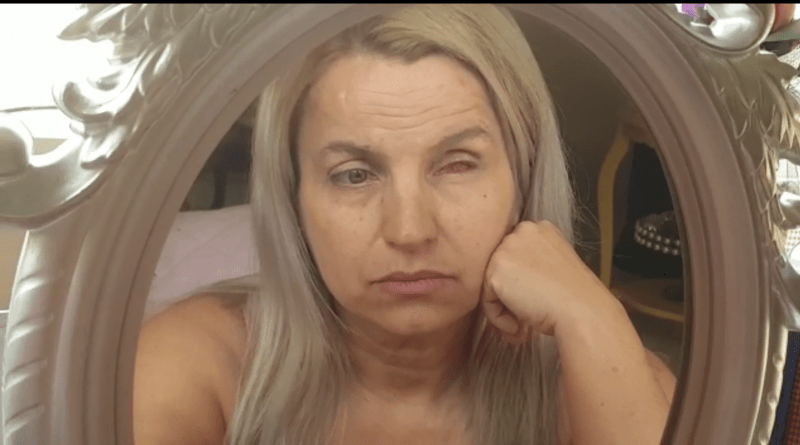 Mulher perdeu a vis&atilde;o total em um dos olhos- Foto: Reprodu&ccedil;&atilde;o/ND