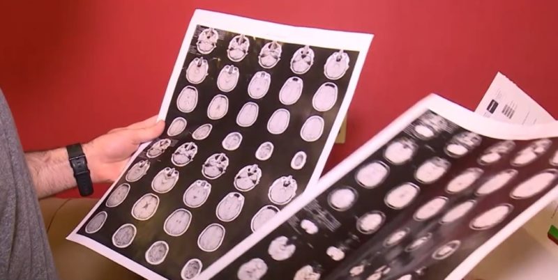 Fábio descobriu um tumor no cérebro em 2017