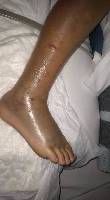 Crian&ccedil;a foi picada enquanto brincada em amontoado de madeira; Menino foi internado e chegou a ficar em estado grave &mdash; Foto: Thammy Grecco/Divulga&ccedil;&atilde;o/ND