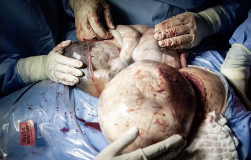 A imagem registra os g&ecirc;meos que nasceram empelicados – Foto: Julianna Pereira/fot&oacute;grafa